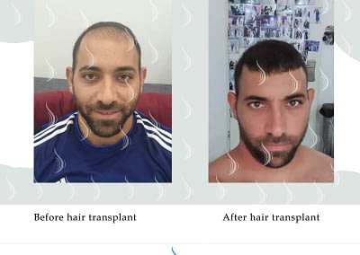 before and after hair transplant
