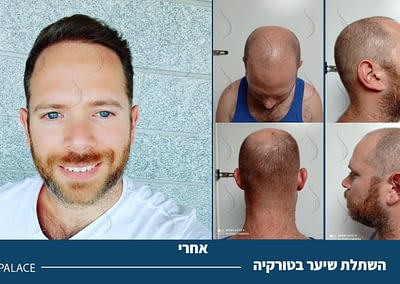 before and after hair transplant